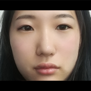 눈밑지방재배치<br>