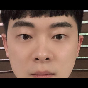 눈밑지방재배치<br>