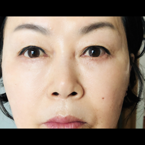 눈밑지방재배치<br>