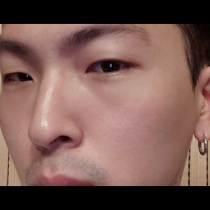 눈밑지방재배치<br>