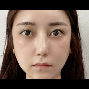 눈밑지방재배치<br>