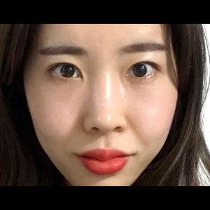 눈밑지방재배치<br>